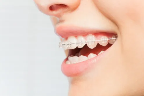 Orthodontic Treatments for Adults: Clear Aligners vs Braces